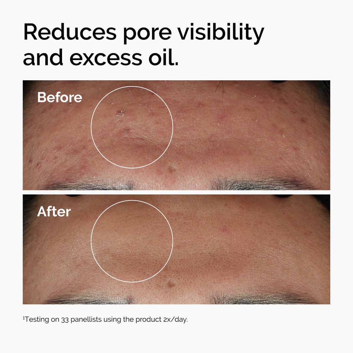 niacinamide-10-zinc-1-b3 ord-niacinamide-zinc-blemish-serum-before-after-pores.jpg