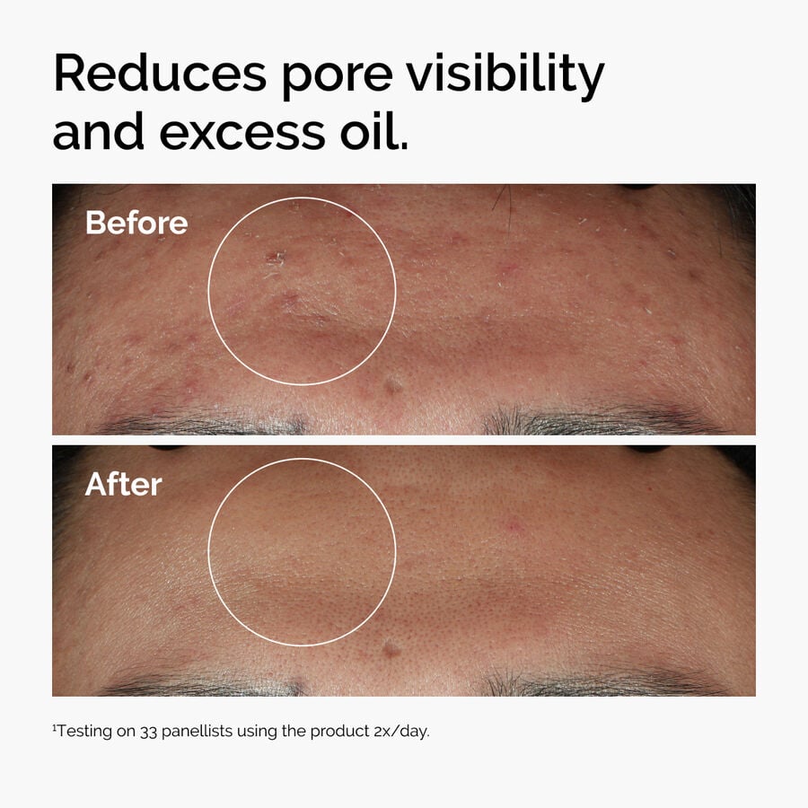 niacinamide-10-zinc-1-b3 ord-niacinamide-zinc-blemish-serum-before-after-pores.jpg
