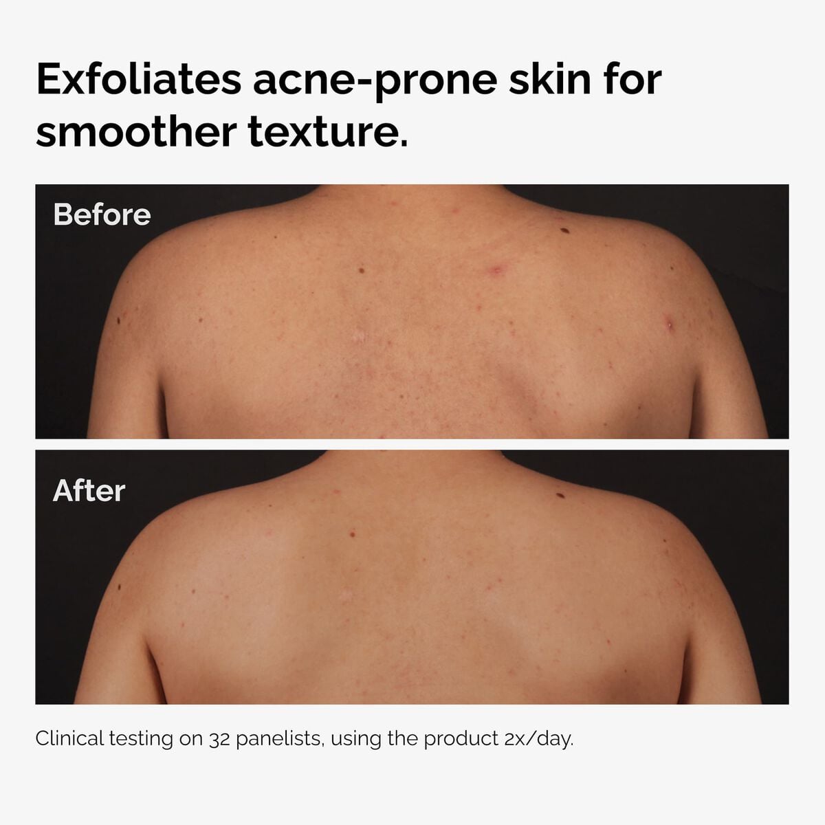 salicylic-acid-0-5-body-serum-j5 ord-salicylic-acid-body-serum-before-after-graphic-NA.jpg