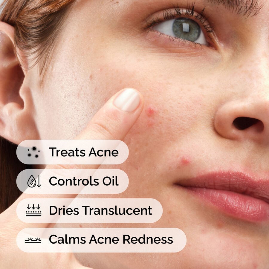 sulfur-10-powder-to-cream-concentrate-u8 ord-sulfur-10pct-powder-to-cream-concentrate-model-application-with-benefits-acne.jpg