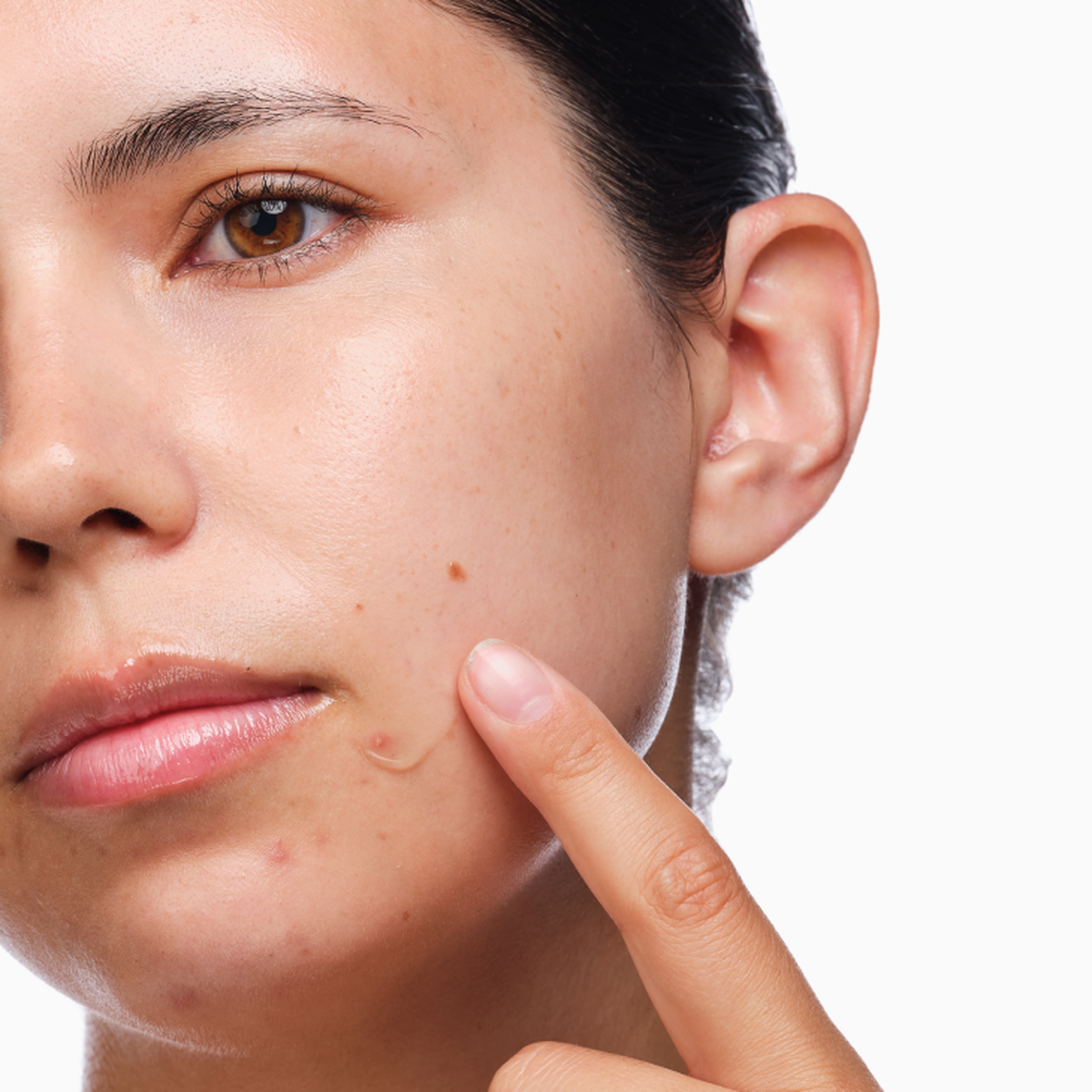 the-acne-set-b8 rdn-the-acne-set-application.png